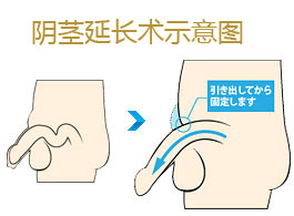 阴茎延长术示意图